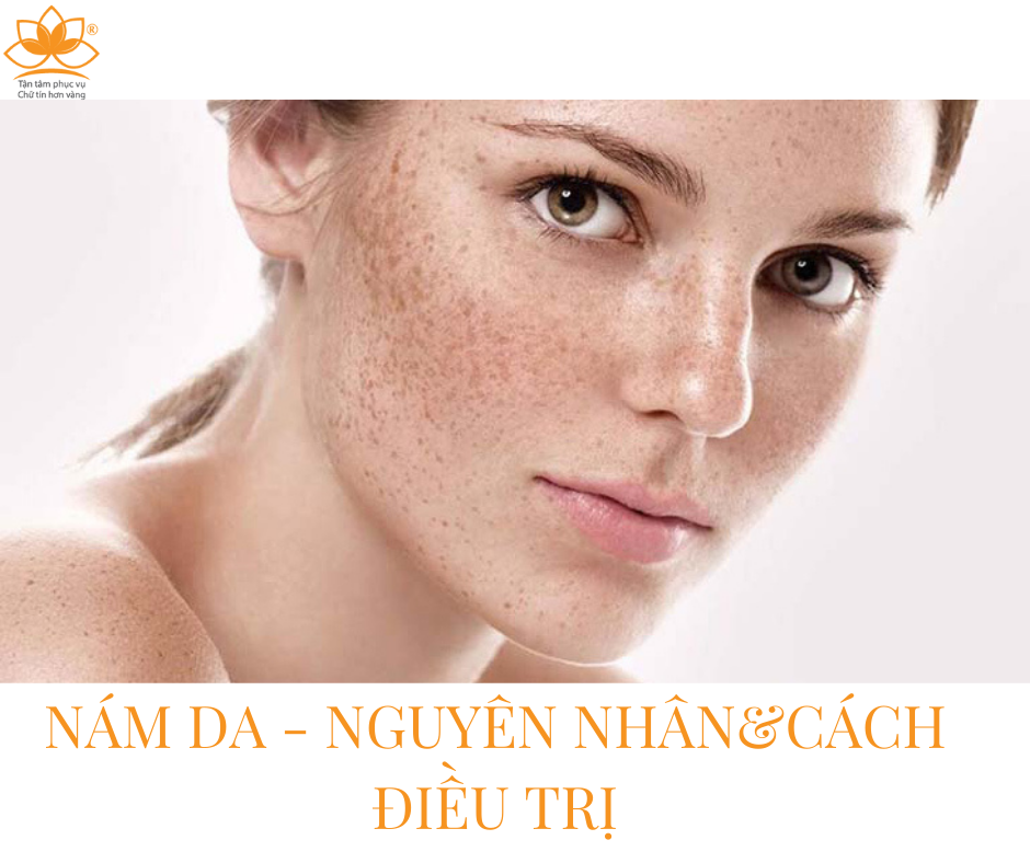 CÁCH ĐIỀU TRỊ NÁM VÀ TÀN NHANG